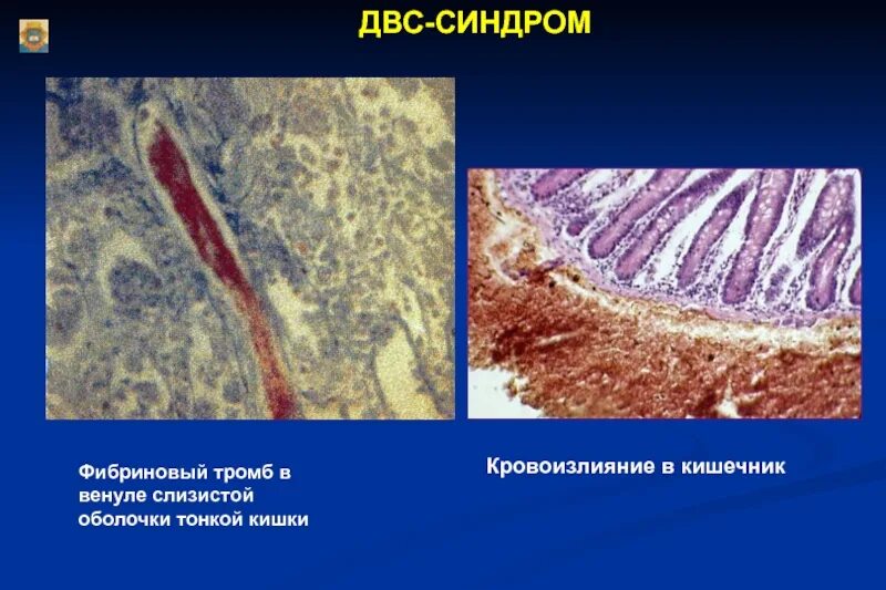 Исход ДВС синдрома патанатомия. Тромбы при ДВС синдроме. ДВС синдром морфология. Тромб нити