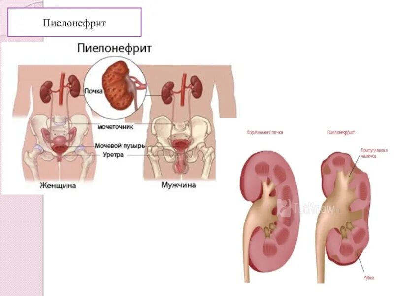 1 острый пиелонефрит. УЗИ почек гестационный пиелонефрит. Острый пиелонефрит Мочеполовая система. Пиелонефрит биология 8 класс. Односторонний и двусторонний пиелонефрит.