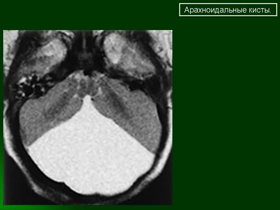 Киста задней черепной ямки кт. Арахноидальная киста заднечерепной ямки кт. Арахноидальная киста кт. Арахноидальная ликворная киста мрт. Киста головного мозга армия