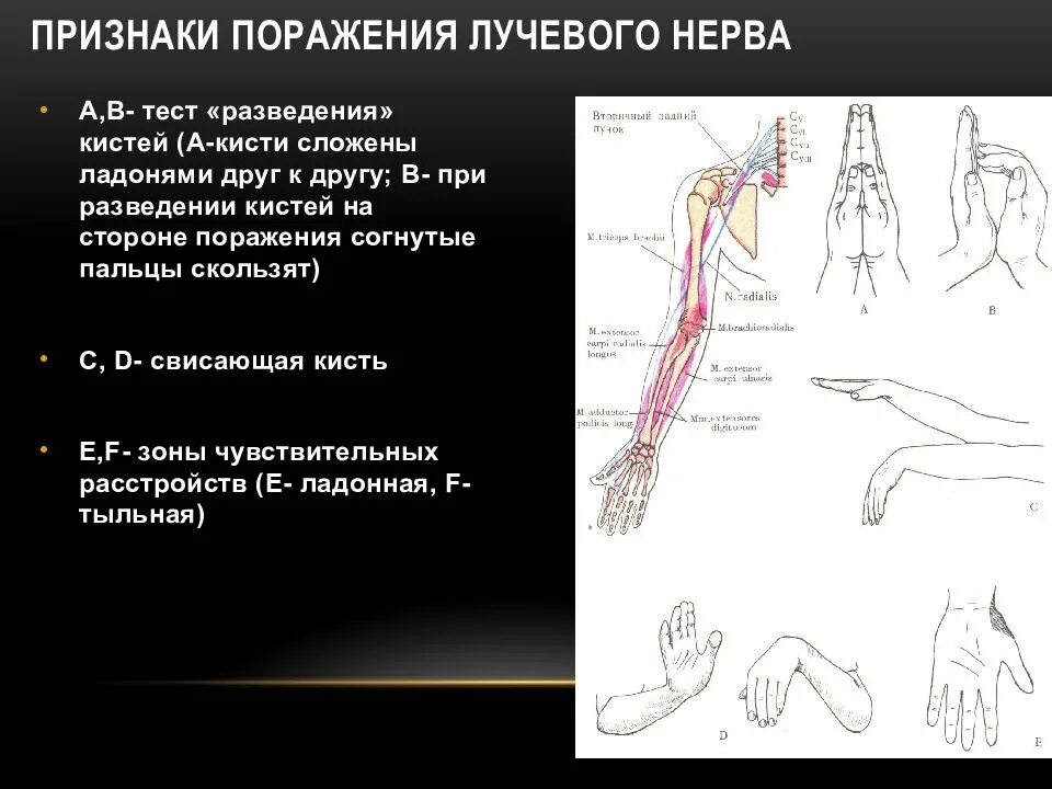 Диагностические тесты повреждения лучевого нерва. Кисть при нейропатии лучевого нерва. Клинические проявления поражения лучевого нерва. Травматический неврит лучевого нерва.