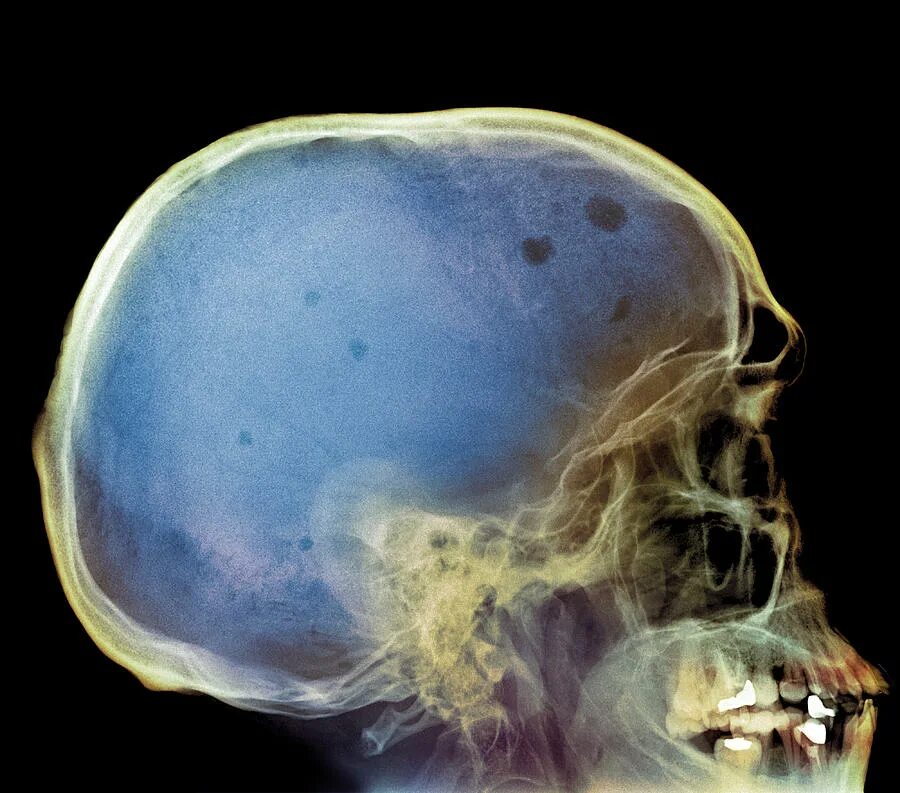 Миеломная болезнь костей черепа рентген. Миеломная болезнь рентген черепа. Миеломная болезнь рентген черепа. Миеломная болезнь клинические проявления. Кости черепа при миеломной болезни макропрепарат.