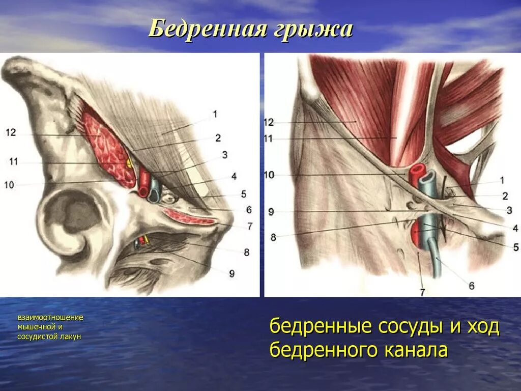 Ущемленная бедренная грыжа. Бедренная грыжа сосудистая лакуна. Бедренное кольцо топографическая анатомия. Бедренные грыжи топографическая анатомия. Сосудистая лакуна топографическая анатомия.