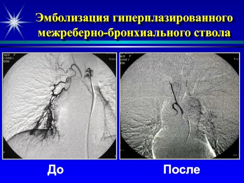 Эмболизация форум. Эмболизация легочных сосудов. эмболизация бронхиальных артерий.