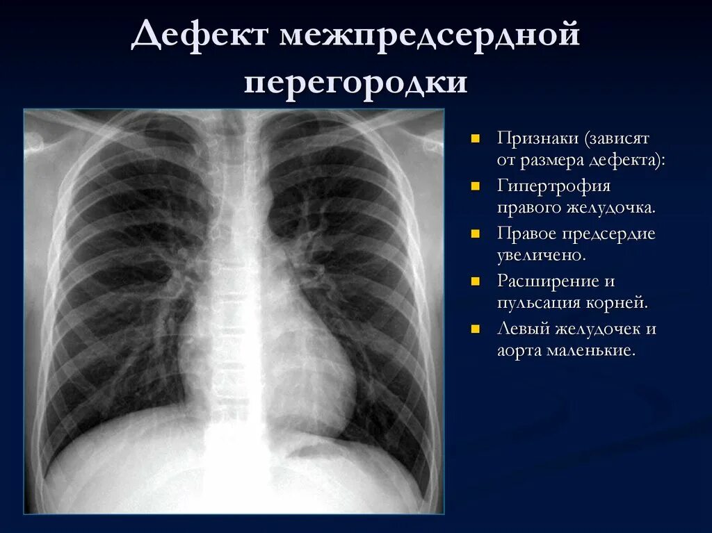 Дефект аортолегочной перегородки тест нмо. Дефект межпредсердной перегородки рентген.