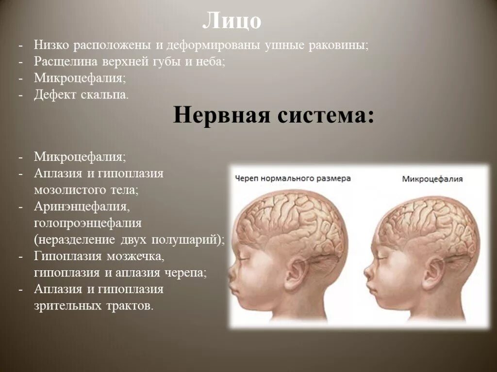 Микроцефалия причины. Недоразвитие мозжечка. Гипоплазия/аплазия мозолистого тела.