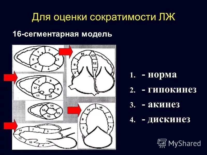Гипокинез передних сегментов. Гипокинез передних сегментов