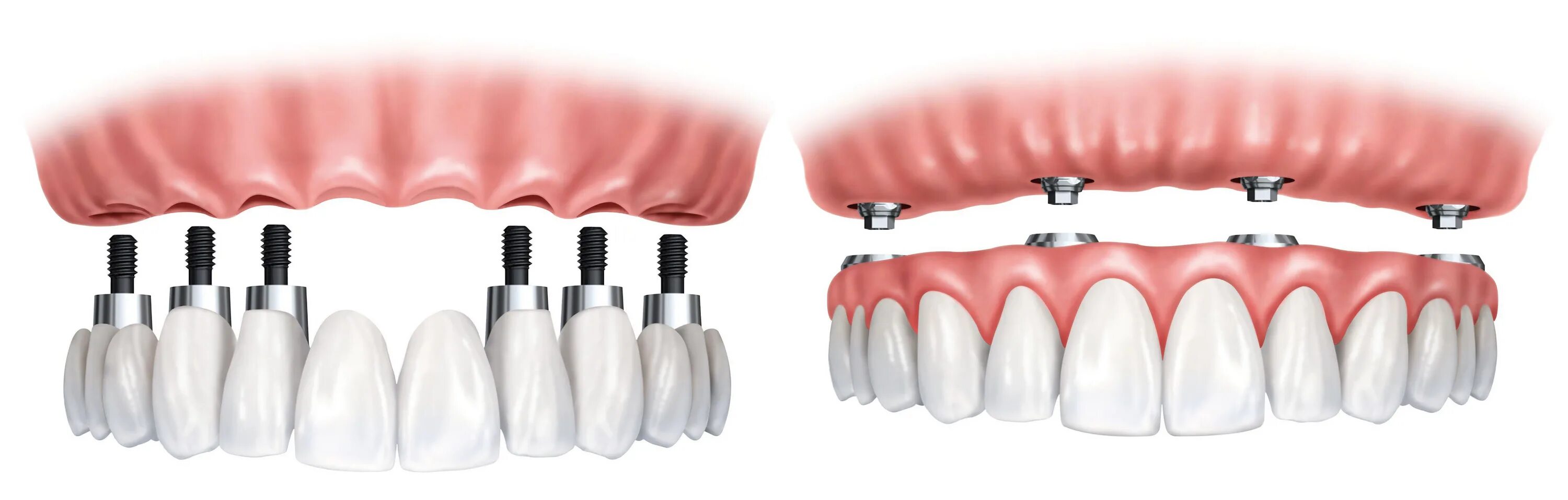 Имплантация зубов на 6 имплантах верхней челюсти. Имплантация all-on-6 (имплантация на 6 имплантах). Имплантация зубов all on 4.