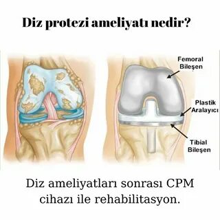 Когда меняют сустав