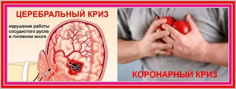 Сосудистый криз. Гипертонический церебральный криз. церебральный сосудистый криз. гипертонический церебральный сосудистый криз. церебральный сосудистый криз симптомы.