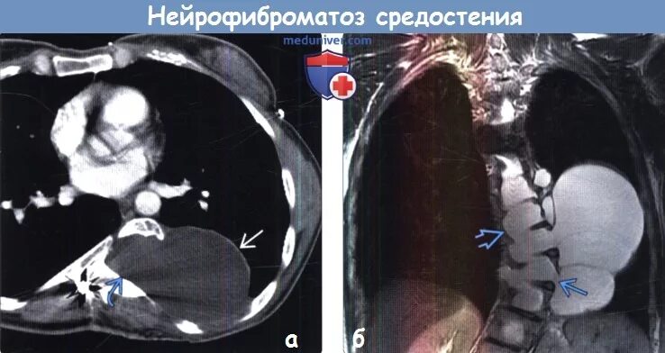 Нейрофиброматоз мрт. Нейрофиброматоз брюшной полости на кт. невринома средостения на кт. нейрофиброматоз позвоночника на кт.