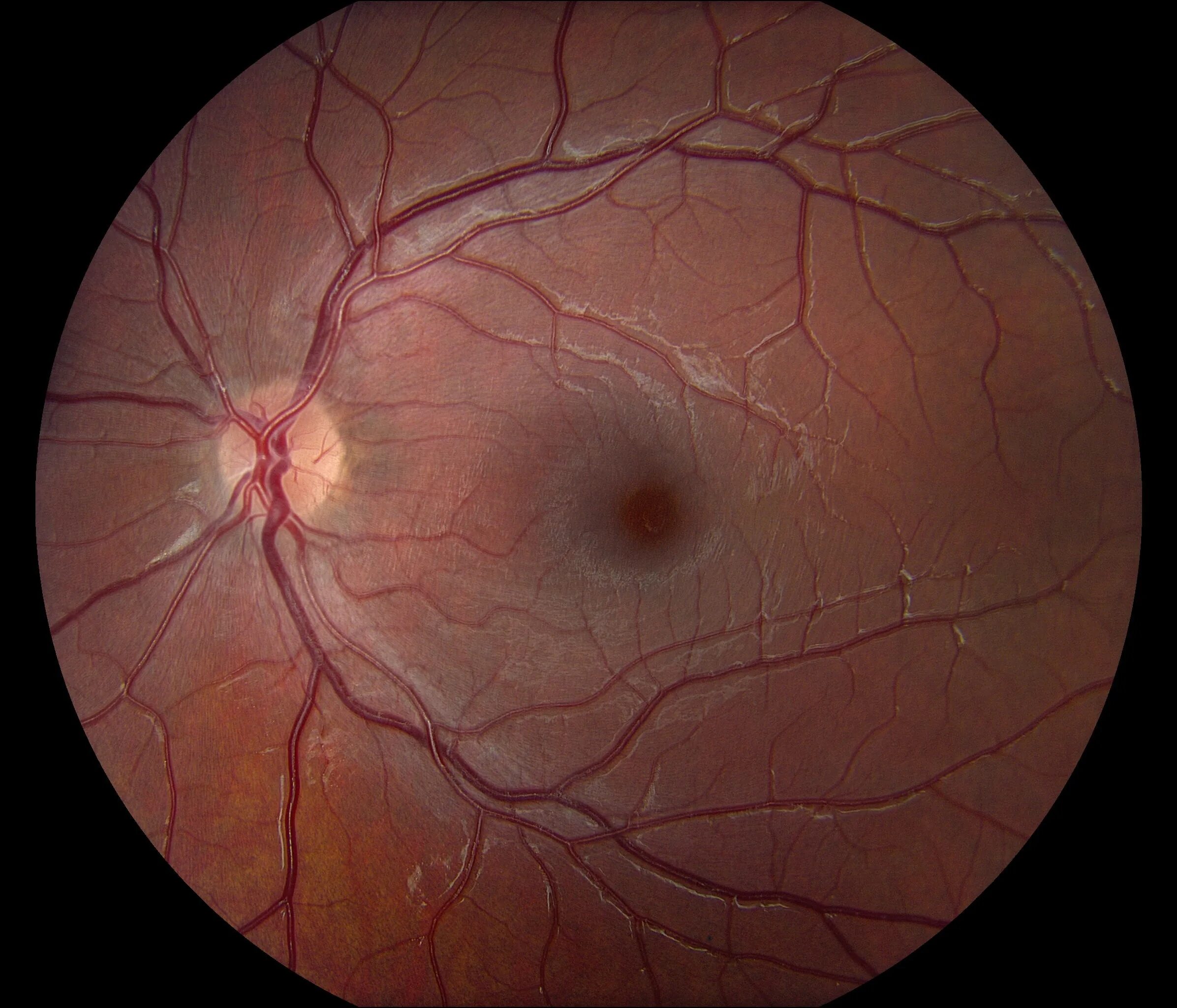 Зрительный нерв при глаукоме. Отслойка сетчатки глазное дно. Неоваскулярная глаукома. Глаукома отслойка сетчатки.