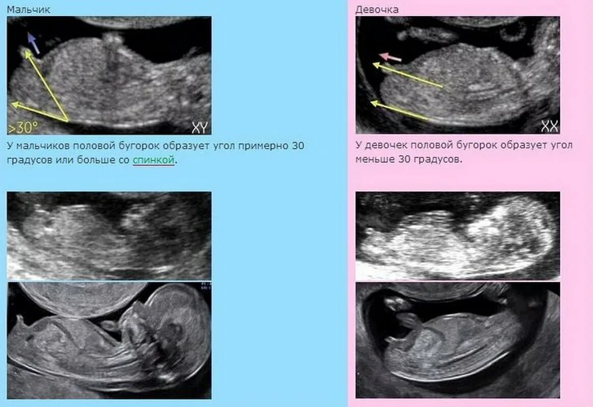 Пол плода на УЗИ В 12 недель беременности. УЗИ 13 недель беременности пол ребенка мальчика. 13 Недель беременности фото плода на УЗИ пол ребенка. Как выглядит мальчик на УЗИ В 12 недель. Как отличить на узи