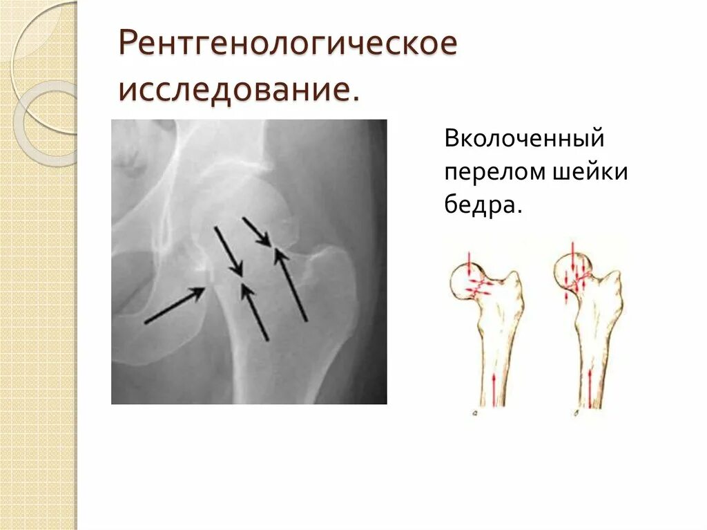 Кортикальный перелом шейки бедра. Перелом шейки бедренной кости. Виды переломов шейки бедренной кости. Субкапитальный вколоченный перелом шейки бедра рентген. Трещина шейки