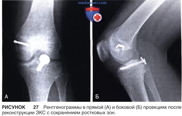 Операция на крестообразной связки рентген. Артроскопическая пластика ПКС. Операция на ПКС коленного сустава на рентгене.