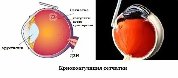 Глазное дно отслоение сетчатки. Субклиническая отслойка сетчатки. Экстрасклеральное пломбирование сетчатки глаза.