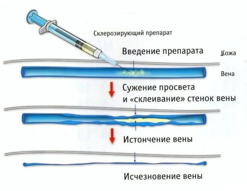 Склеротерапия варикозной болезни. Склерозирование стенок сосудов что это. Эндоваскулярная склеротерапия.