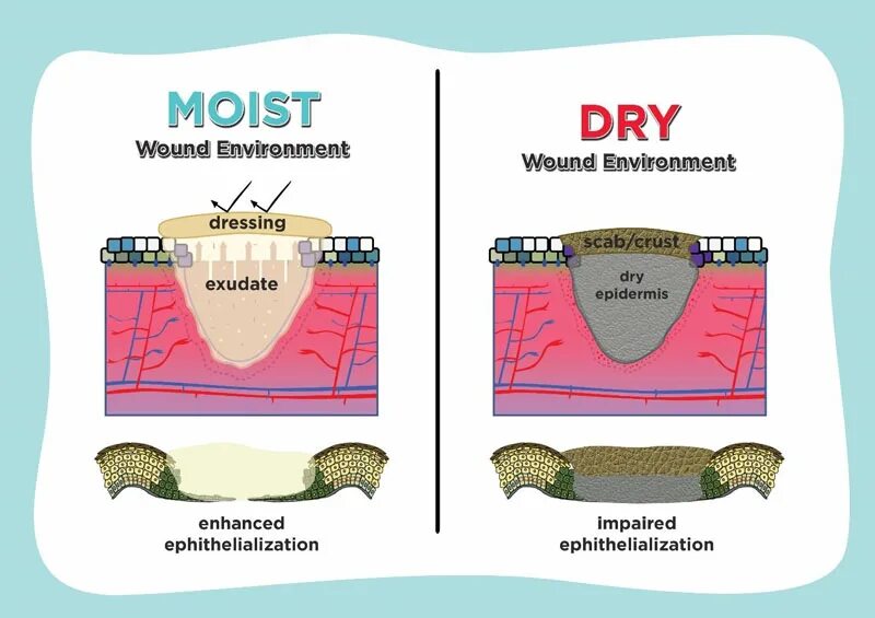 What is a wound. Dry leeward. successive stages of wound epithelialization.