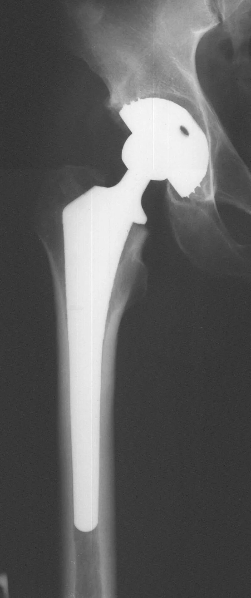 Перелом шейки бедра остеосинтез. Перелом проксимального отдела бедренной кости. Перелом шейки бедра эндопротез. Медиальный перелом шейки бедра.