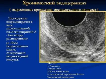 Что такое экзоцервикс и эндоцервикс в гинекологии