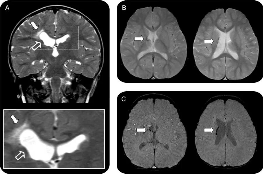 Кт анатомия головного мозга аксиальные срезы. Кт с контрастом и без. Вазогенный отек головного мозга кт. Плотность головного мозга на кт. Плотность ишемического инсульта на кт.