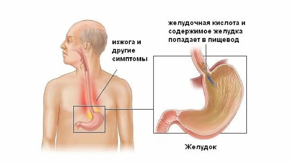 Пищевод открывается в желудок. Желчи в желудок заброс желчи. Содержимое желудка в пищеводе.