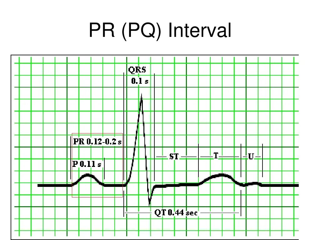 Интервал pr. Qrs. интервал pq. wave p qrs. qt на экг.