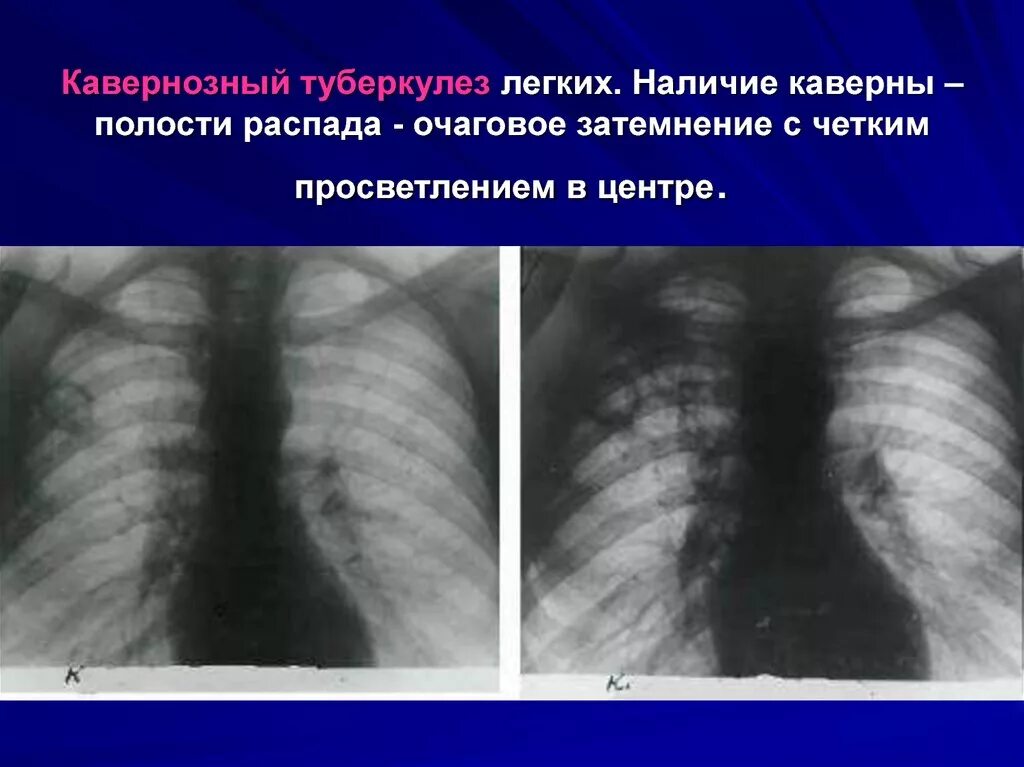 Распад симптомы. Туберкулез милиарный каверны. Инфильтративный туберкулез рентген. Инфильтративный туберкулез легкого рентген. Кавернозный туберкулез рентген.