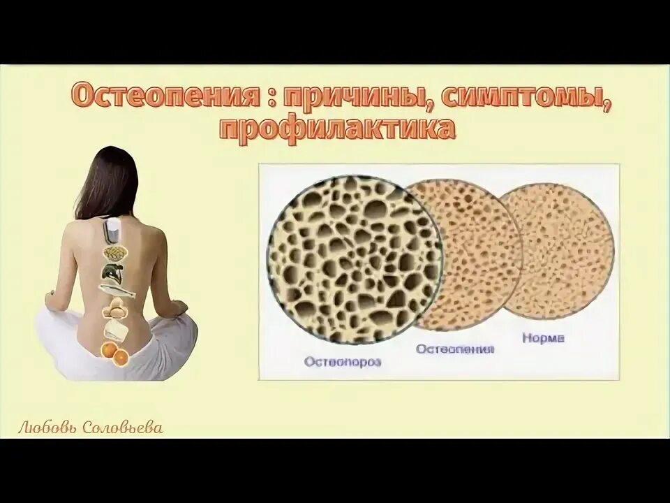 Остеопении