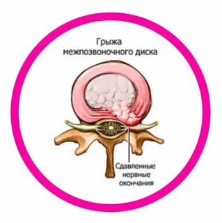 Защемление грыжи симптомы