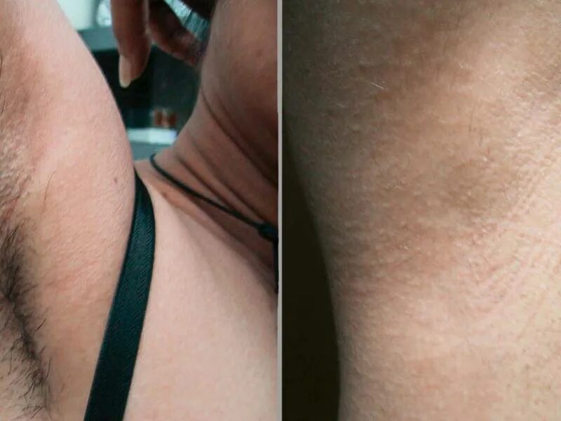 Лазерная эпиляция бикини элос. Депиляция глубокое бикини. Эпиляция тотальное бикини. Фотоэпиляции бикини глубокого. Электроэпиляция зона бикини до и после.