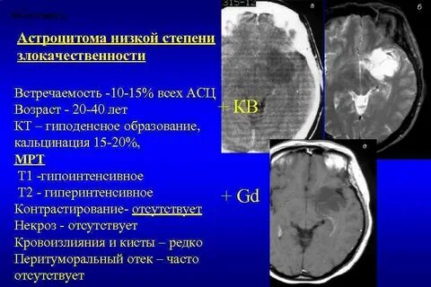 Опухоль мозга стадии