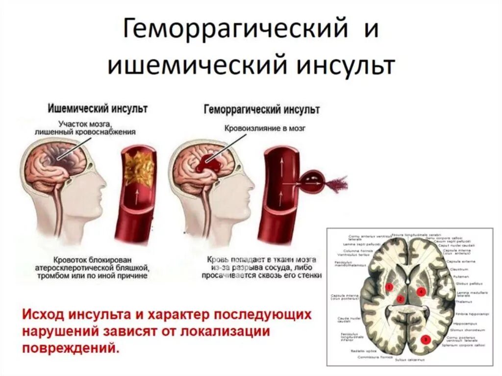 Лечение ишемического инсульта головного. Геморрагический инсульт разрыв сосуда. ОНМК геморрагический инсульт симптомы. Геморрагический паренхиматозный инсульт симптомы. Ишемический и геморрагический инсульт головного мозга.