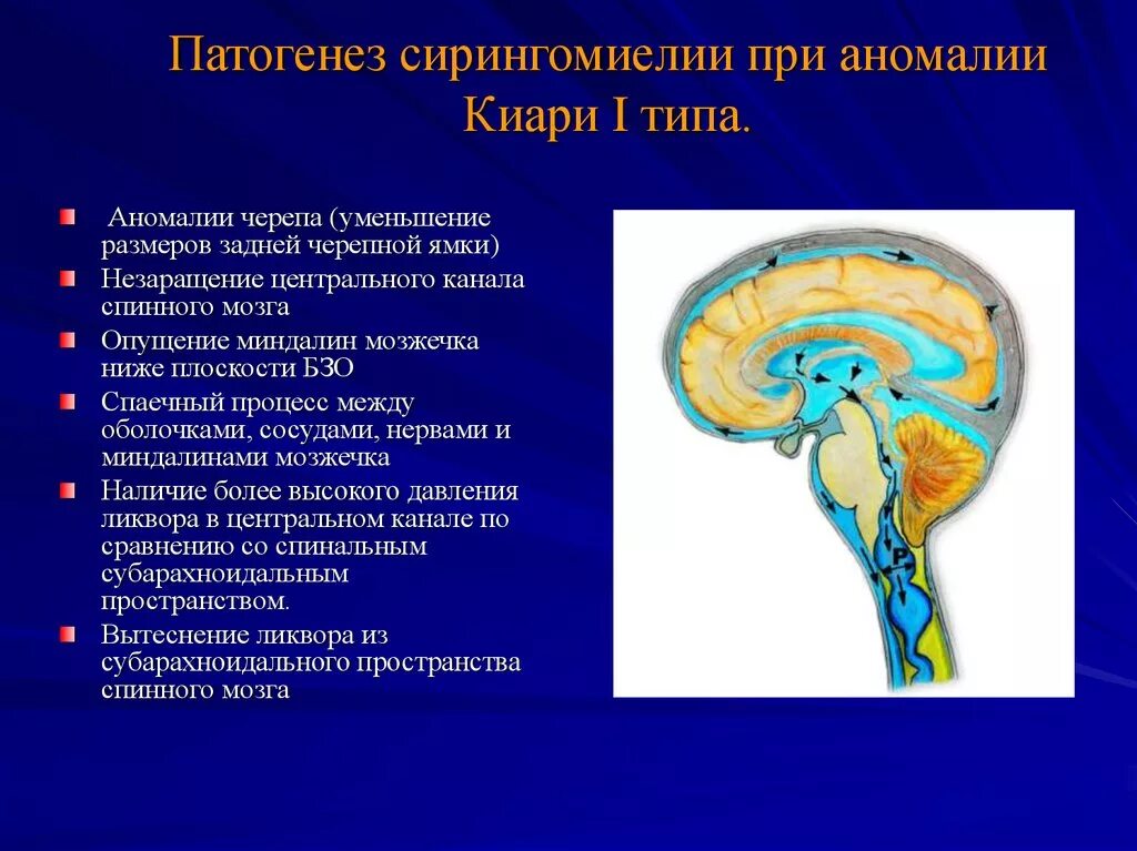 Аномалия арнольда киари что это простыми. Аномалия Арнольда Киари опущение мозжечка. Сирингомиелия патогенез. Сирингомиелия этиология. Аномалия Арнольда Киари с сирингомиелией.