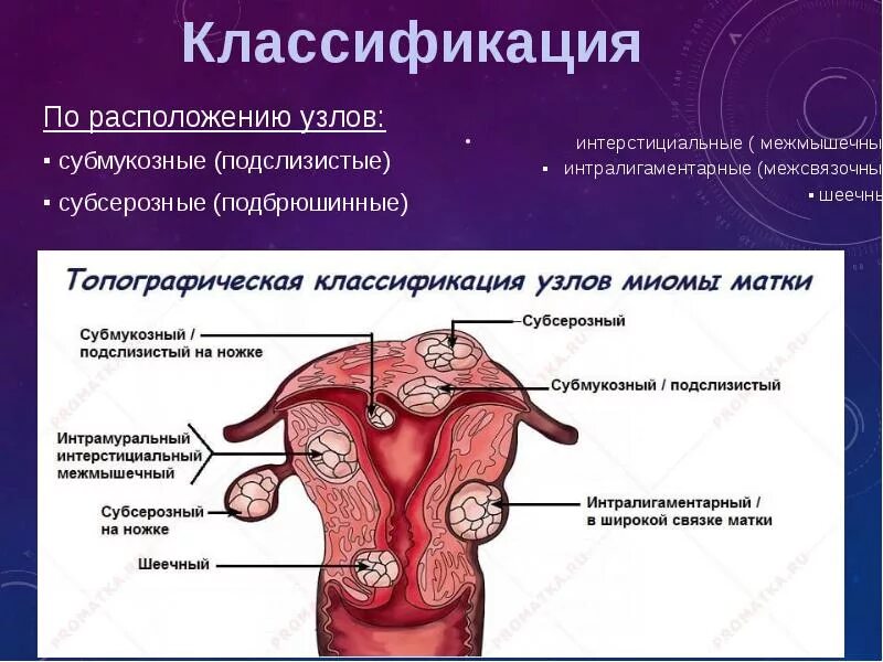 Миома на задней стенке матки