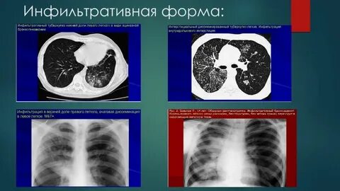Типы инфильтрации легких