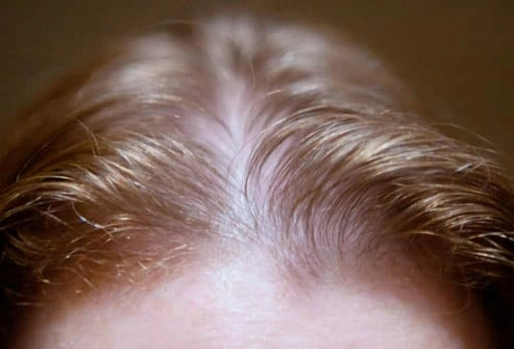 Редкие волосы. Диффузное поредение волос. Диффузная телогеновая алопеция. Болят корни волос на макушке