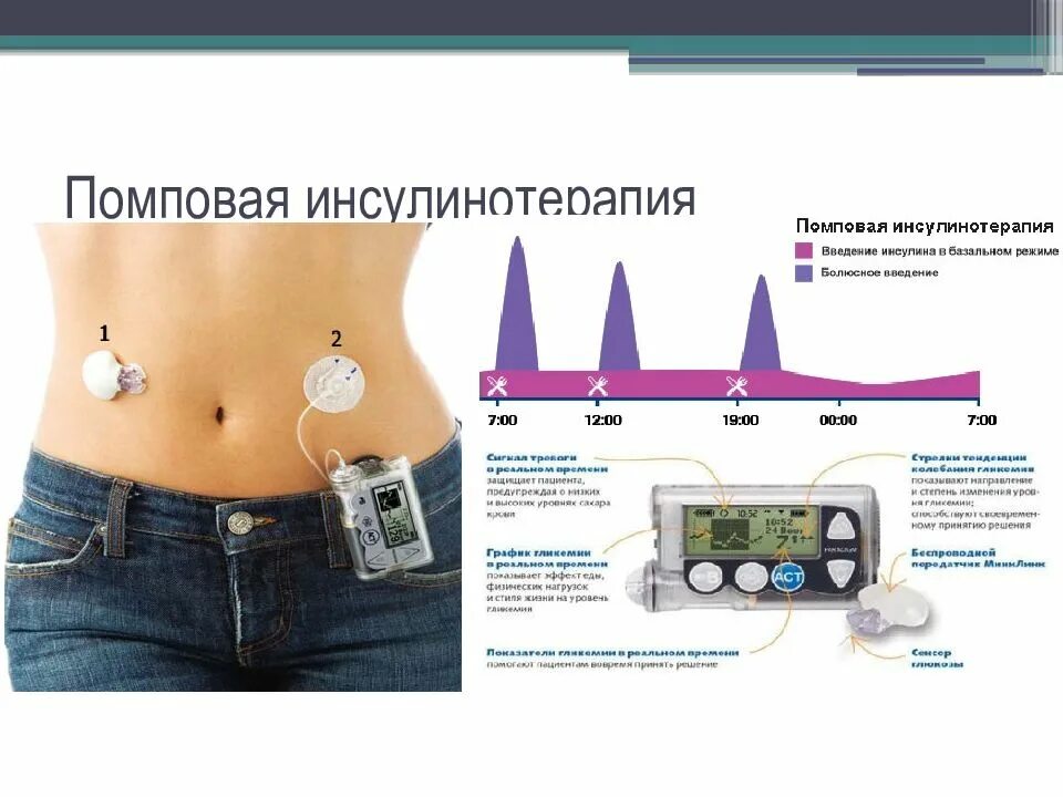 Помповая инсулинотерапия