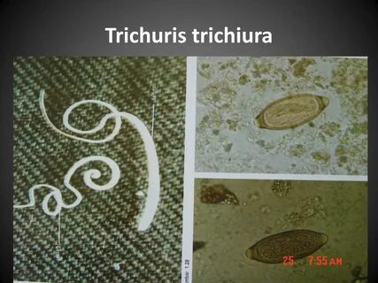 Трихинеллез аскаридоз