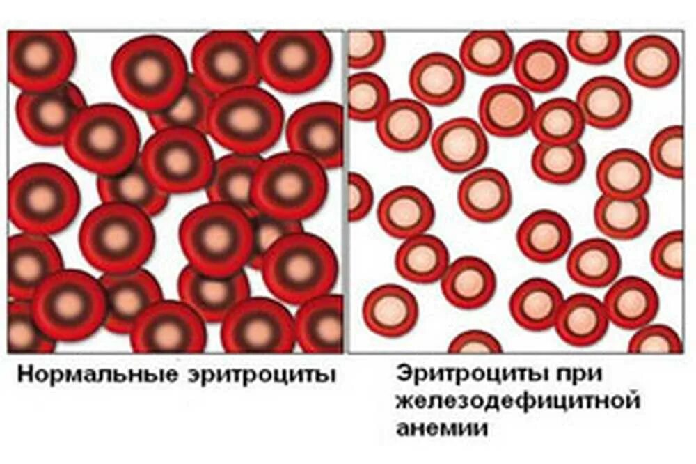 Эритроциты у беременных. Железодефицитная анемия кольцевидные эритроциты. морфология эритроцитов при железодефицитной анемии. насыщенность эритроцитов гемоглобином при железодефицитной анемии. особенности эритроцитов при железодефицитной анемии.