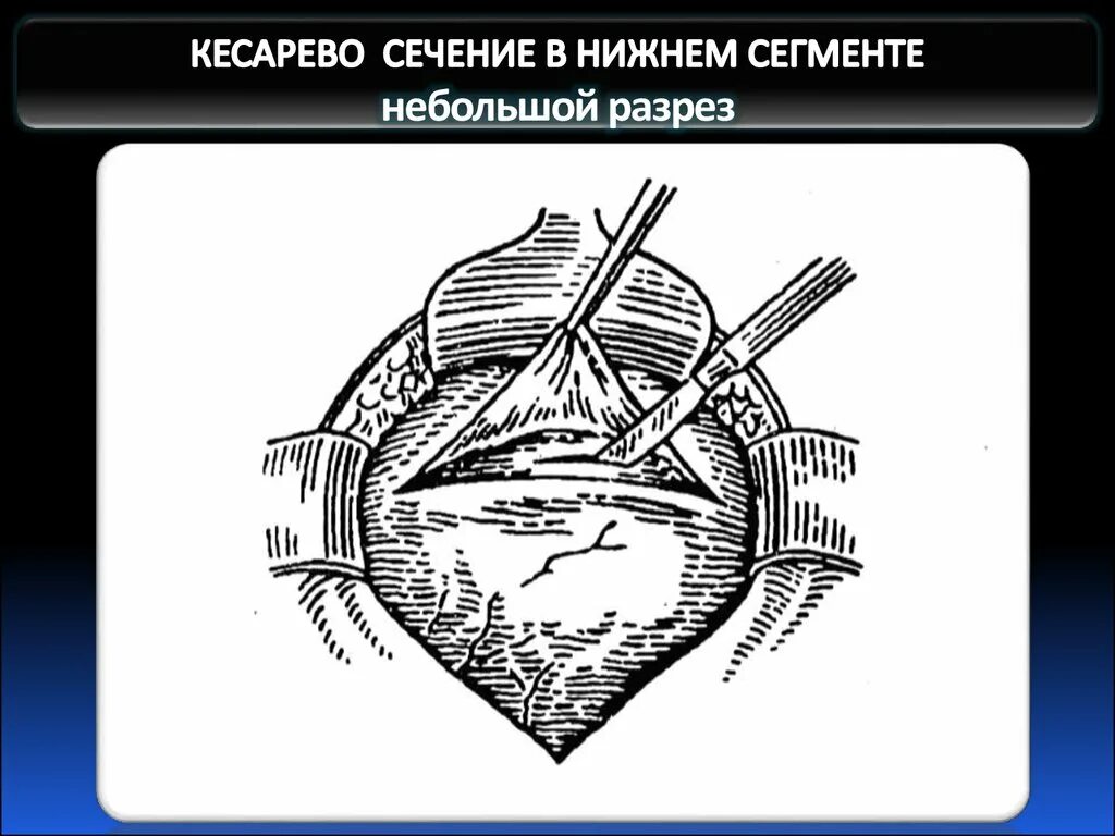 Сегмент матки. Кесарево сечение разрез. разрезы при кесаревом сечении. разрез в нижнем сегменте матки. кесарево в нижнем сегменте.
