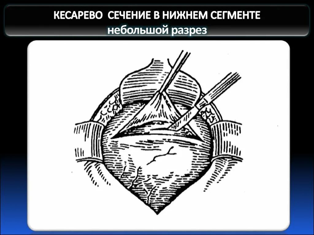 Кесарево сечение разрез. Разрезы при кесаревом сечении. Разрез матки в Нижнем сегменте. Кесарево в Нижнем сегменте.