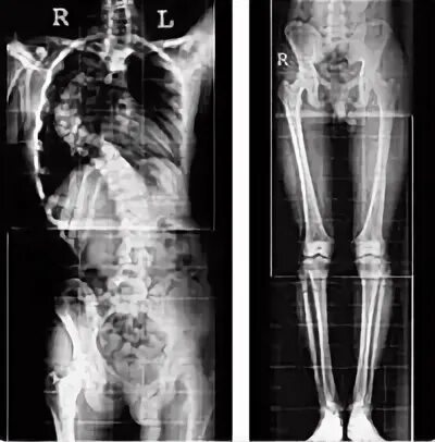 Рентген бедренной кости стоя. Slot рентгенография. Рентген позвоночника сшивка. Топограмма нижних конечностей рентген.