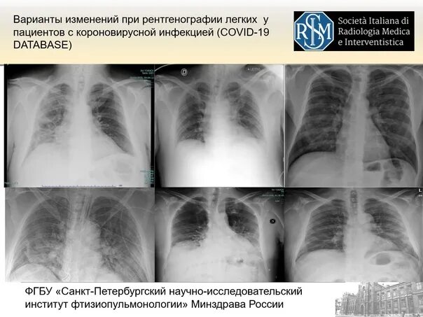 50 процентов легких. Кт диагностика поражения легких при Covid-19.. Коронавирус поражение легких. Поражение легких при коронавирусе. Снимок легких с осложнениями.