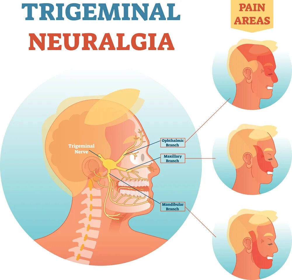 От чего может болеть челюсть. Воспаление тройничного нерва симптомы. Невралгия тройничного нерва 1. Оспалениетройничного нерва. Тройничный нерв восполен.