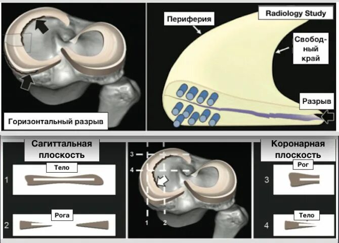 Задний рог медиального мениска 2 степени. Классификация разрывов мениска stoller. классификация повреждения менисков по stoller. разрыв медиального мениска stoller 3б. повреждение 2 по stoller мениска коленного сустава.