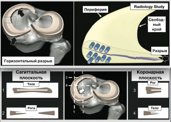 Повреждение мениска коленного сустава по stoller. Классификация разрывов мениска Stoller. Разрыв заднего рога медиального мениска Stoller 2. Классификация повреждения менисков по Stoller. Разрыв медиального мениска Stoller 3б.