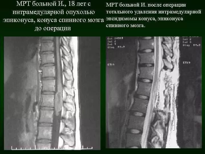 Эпендимома спинного. Эпендимома терминальной нити спинного мозга мрт. Эпендима спинной мозг. Экстрадуральные опухоли спинного мозга. Невринома поясничного отдела позвоночника мрт.