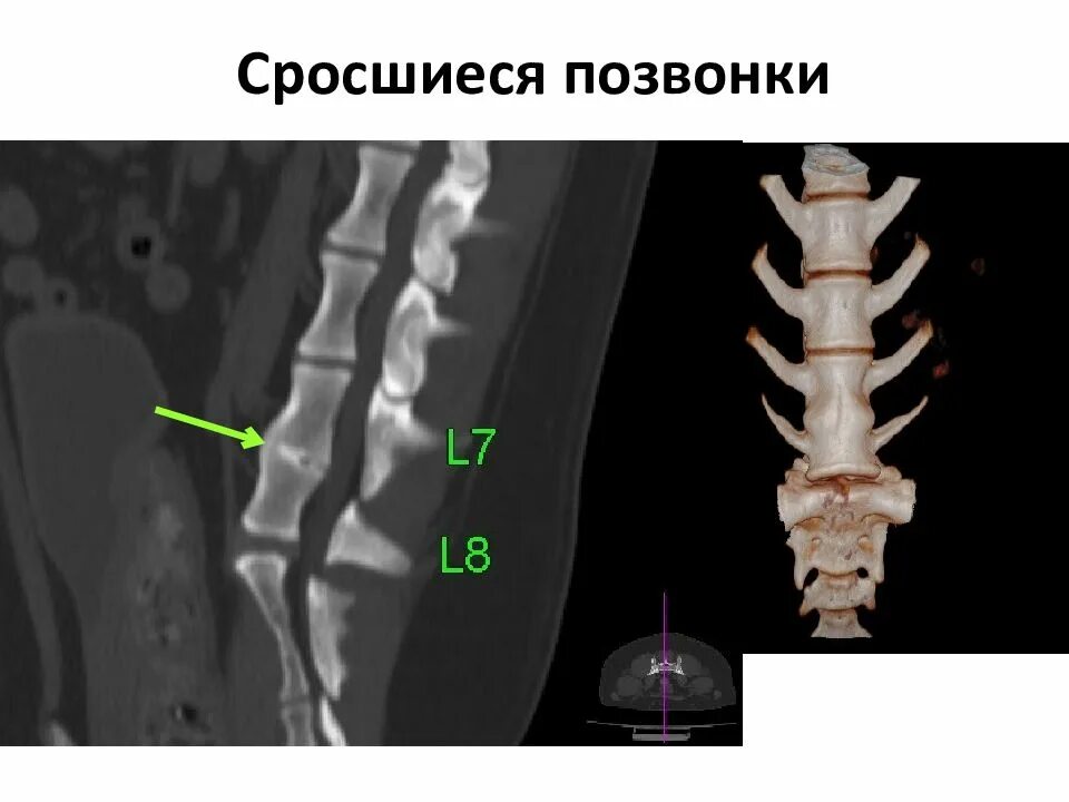 Конкресценция с4-с5. Сросшиеся позвонки. Сросшиеся позвонки в поясничном отделе.