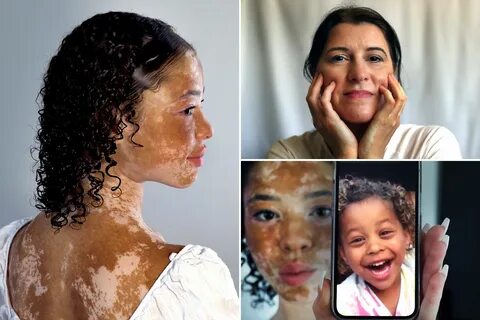 vitiligo pigmentation - www.techiecentral.com.