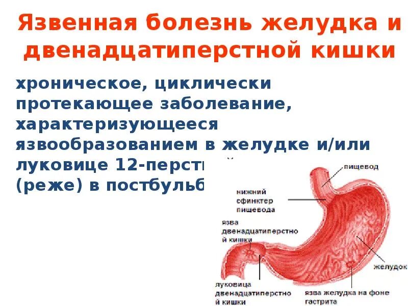 Какие боли при язве двенадцатиперстной. Язва желудка и луковицы 12 перстной кишки. язва желудка и 12 ти перстной кишки. жкт луковица 12 перстной кишки. язвенная болезнь луковицы двенадцатиперстной кишки.
